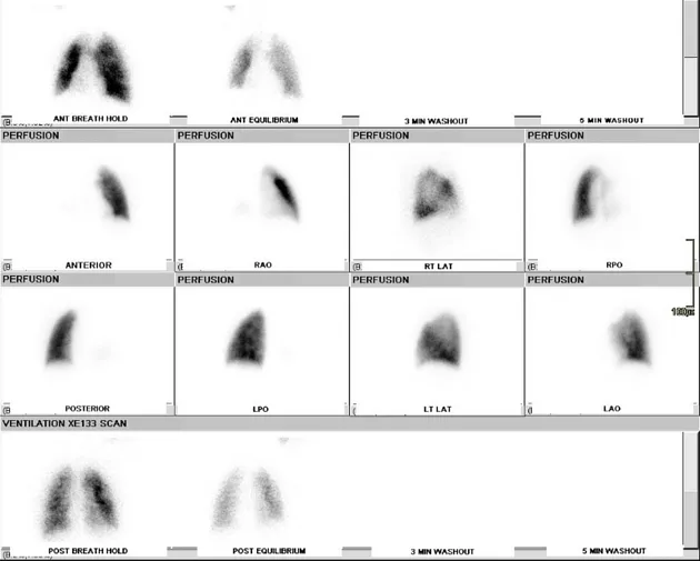Pulmonary angiogram showing perfusion defect characteristic of pulmonary embolism