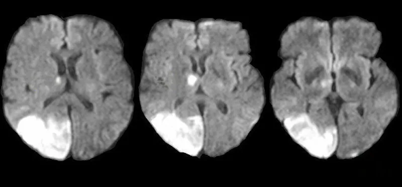 Diffusion-weighted MRI showing posterior cerebral artery stroke with visual cortex involvement