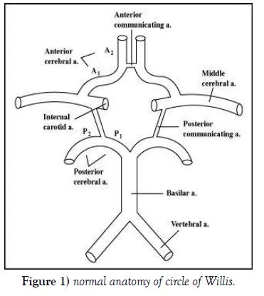 Anatomical diagram comparing normal versus variant Circle of Willis configurations