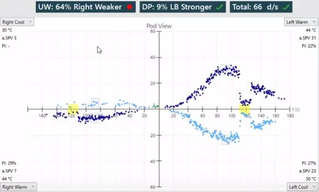 Caloric testing showing unilateral vestibular weakness