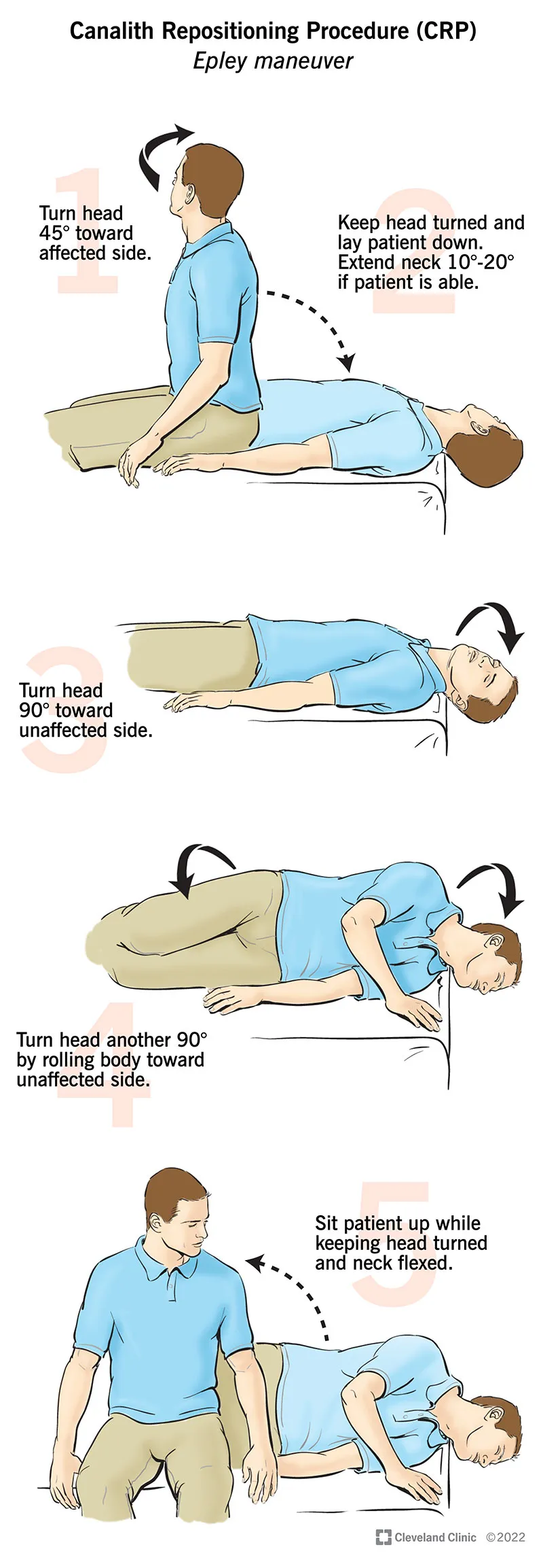 Canalith repositioning procedure for BPPV treatment