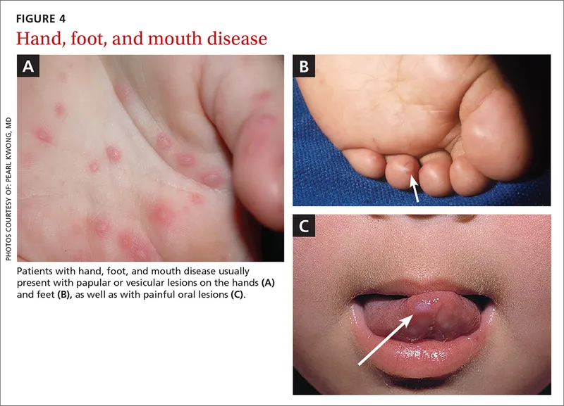 High-yield clinical discriminators for rapid viral skin infection diagnosis