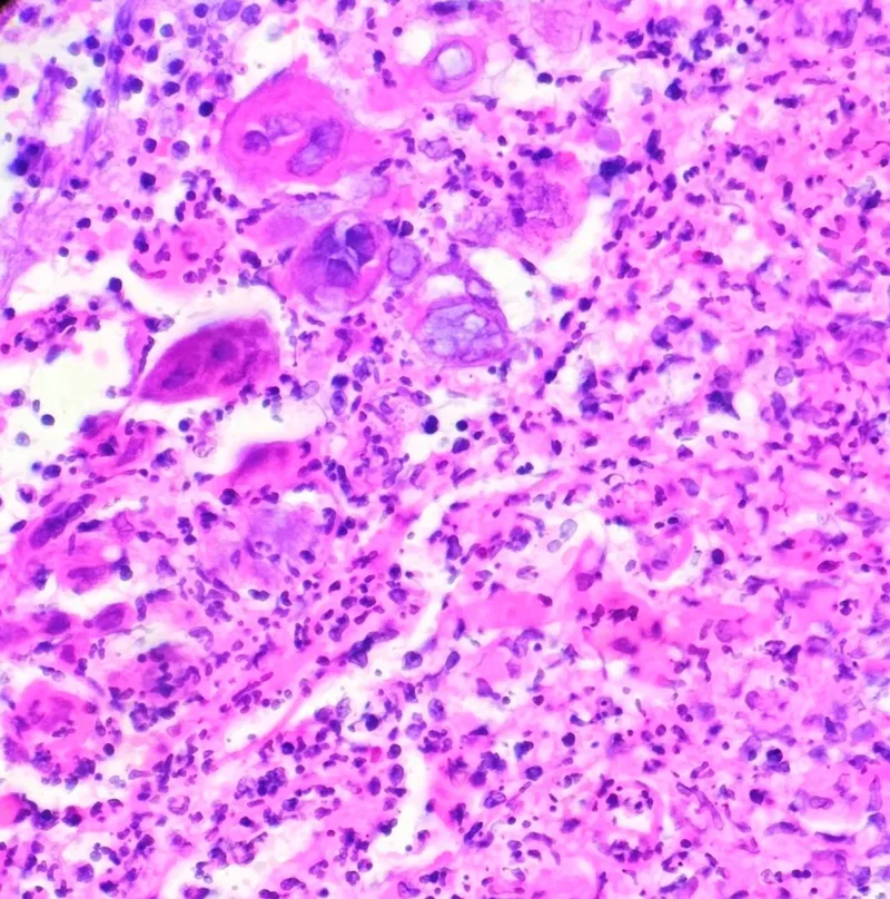 Comparative histopathology of viral versus bacterial skin infections