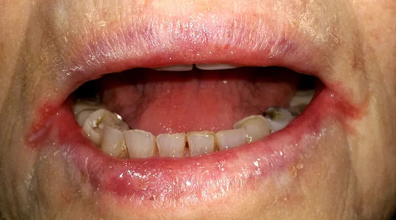 Clinical photograph showing angular cheilitis and glossitis characteristic of riboflavin deficiency