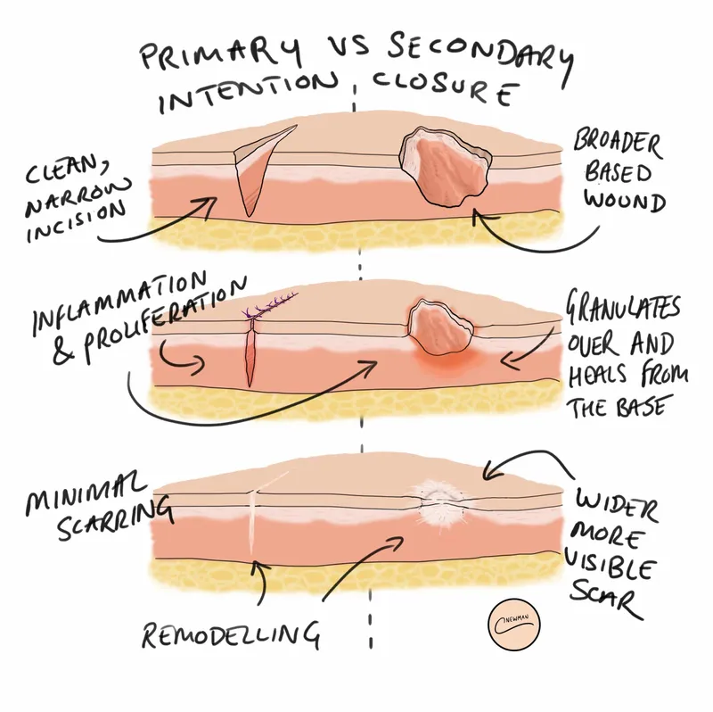 Comparison of primary versus secondary intention wound healing showing different healing patterns