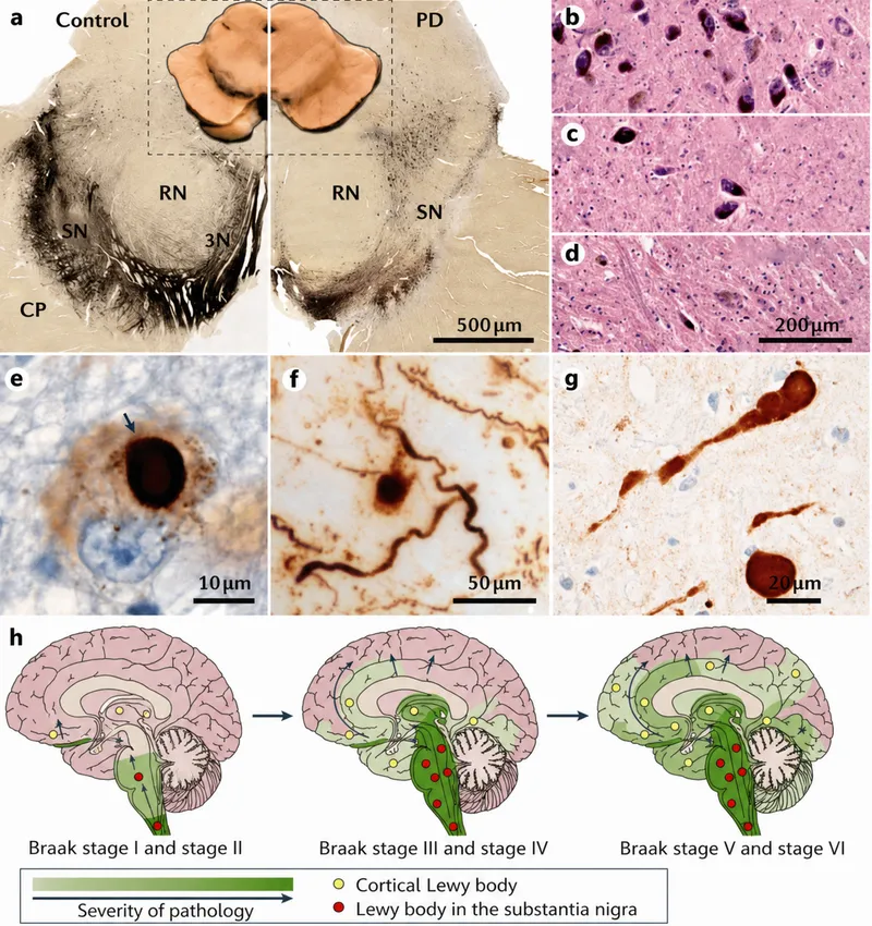 Parkinson's disease pathology