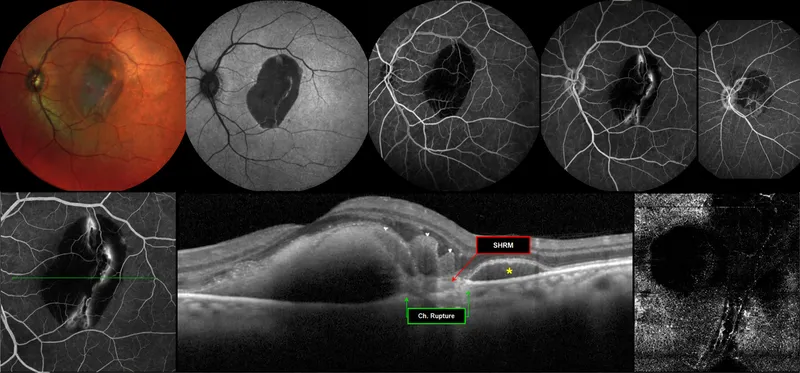 Ocular Trauma: Commotio Retinae, Choroidal Rupture