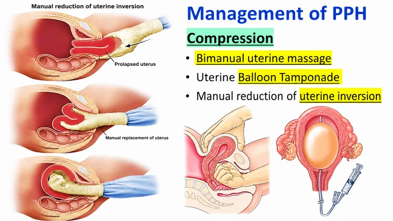 PPH Management: Compression Techniques