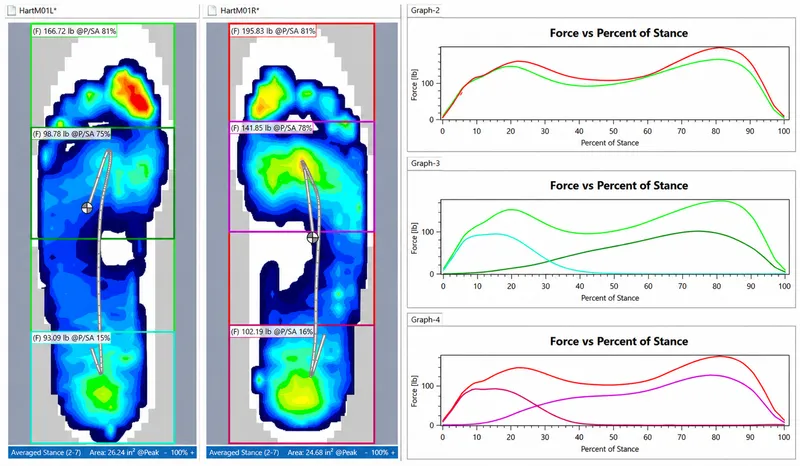 Pressure mapping analysis showing foot loading patterns during gait