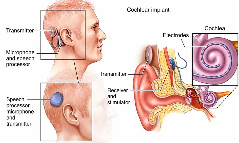 Cochlear Implant Components and Placement