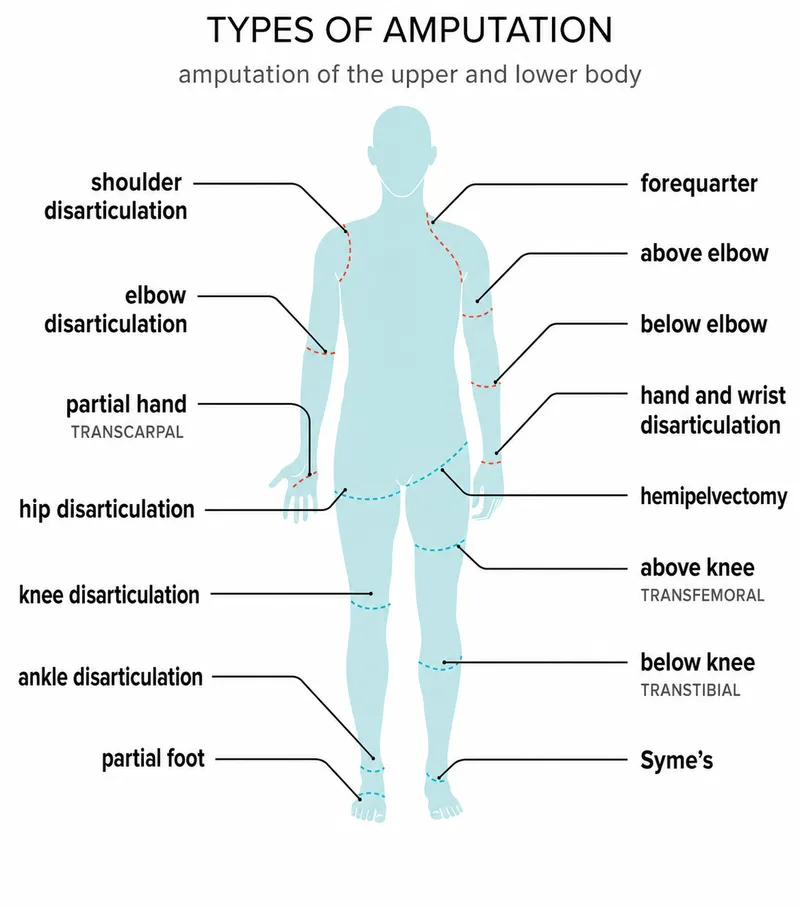 Amputation Levels: Upper and Lower Limbs