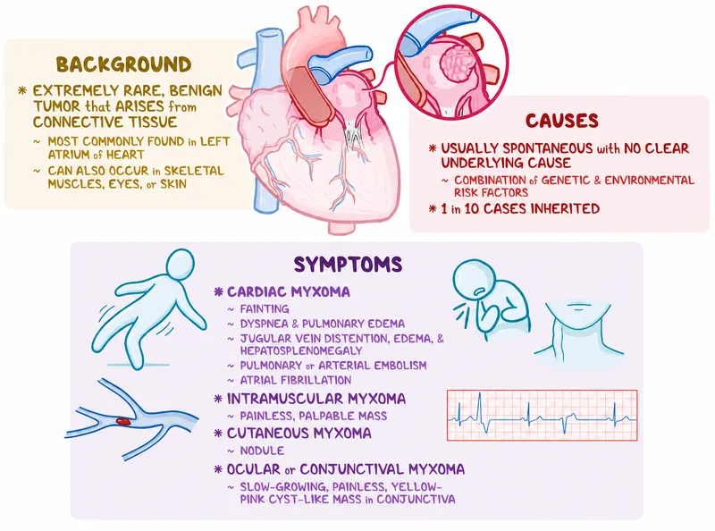 Cardiac Myxoma Background, Causes, and Symptoms