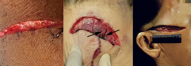 Laceration vs. Incised Wound: Tissue Bridging