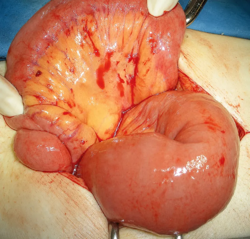 Intraoperative view of adhesive small bowel obstruction showing bowel distension