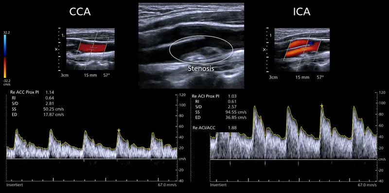 Carotid Artery Stenosis: Color and Spectral Doppler