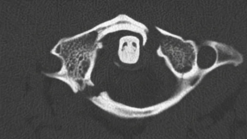 Jefferson Fracture C1 CT Axial View