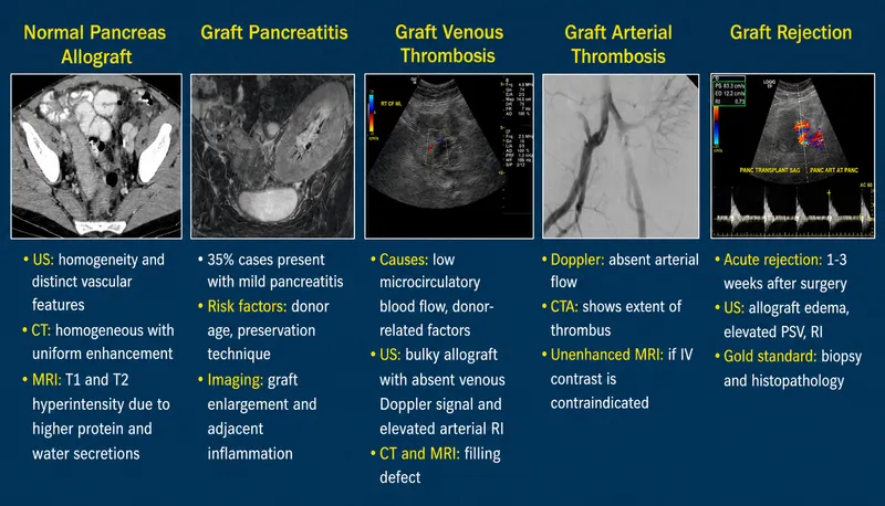 Imaging of Pancreas Transplant Complications