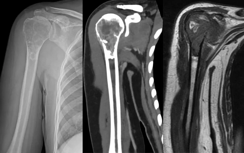 Pre-op imaging for limb salvage surgery planning