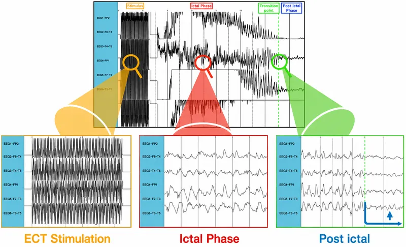 EEG waveform during ECT seizure phases