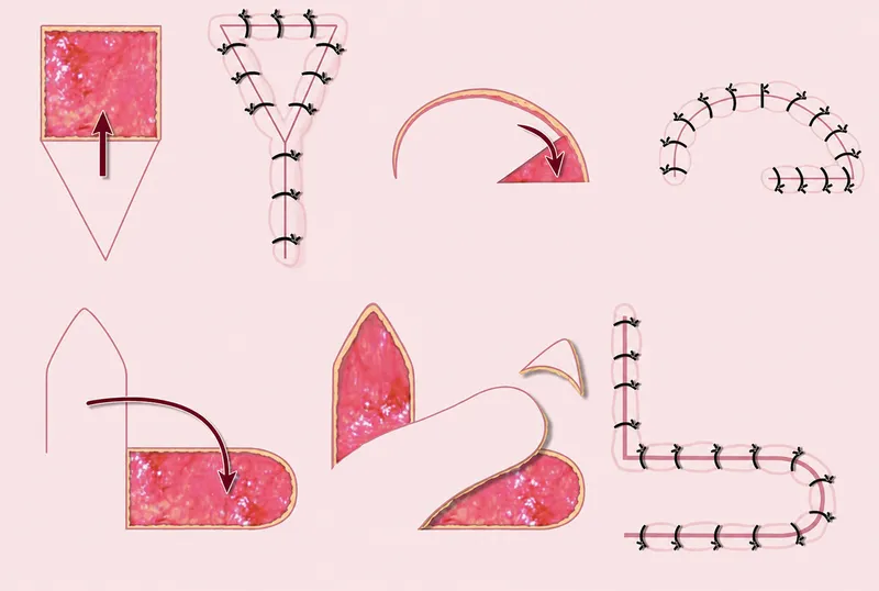 Advancement, Rotation, and Transposition Flaps