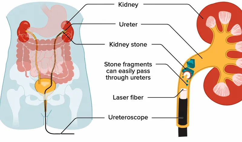 Ureteroscopy with laser lithotripsy
