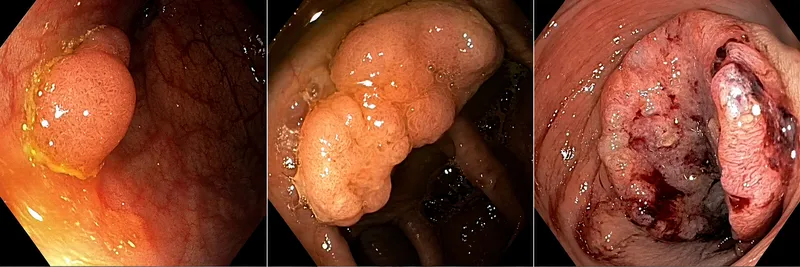 Colonoscopy views of colorectal adenocarcinoma