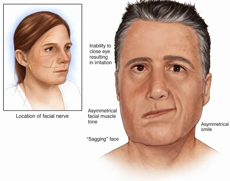 Facial Nerve Paralysis Symptoms and Nerve Location