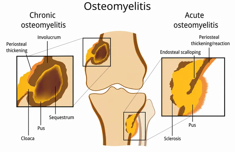 Chronic vs Acute Osteomyelitis Diagram