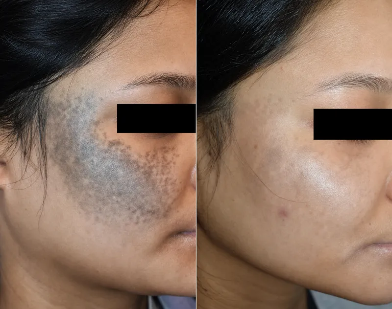 Nevus of Ota before and after laser treatment