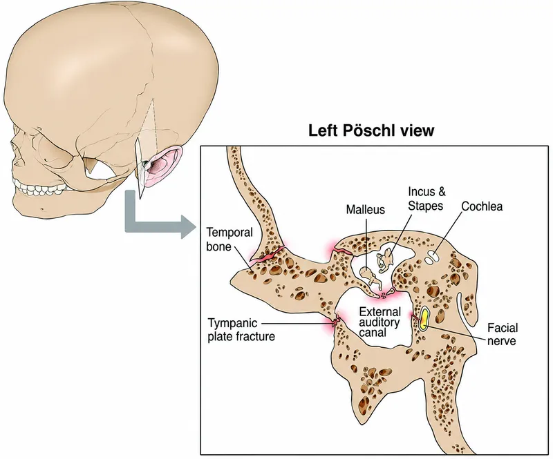 Temporal Bone Fracture with Tympanic Plate Involvement