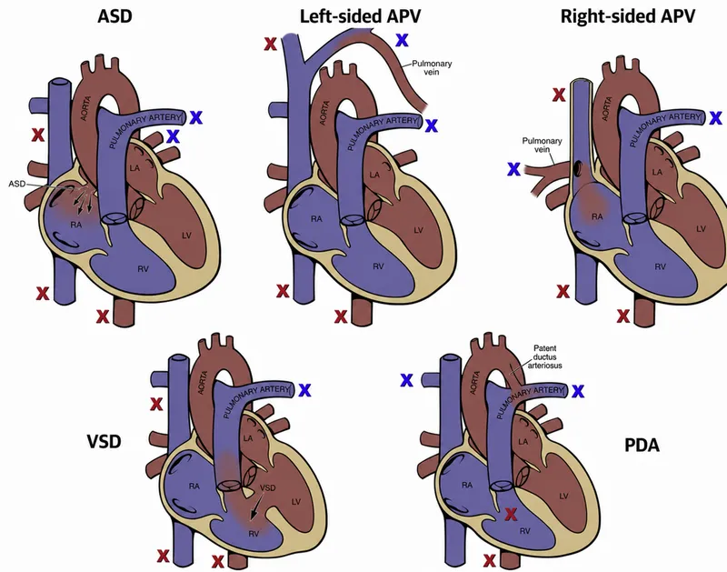 Oximetry step-up in shunt lesions