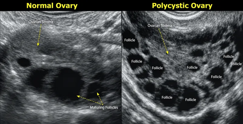 Ultrasound: Normal vs Polycystic Ovary
