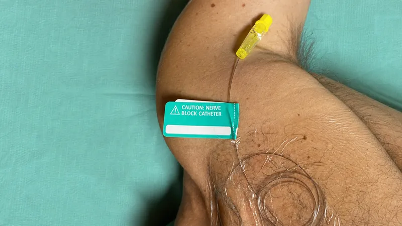 Perineural Catheter Placement
