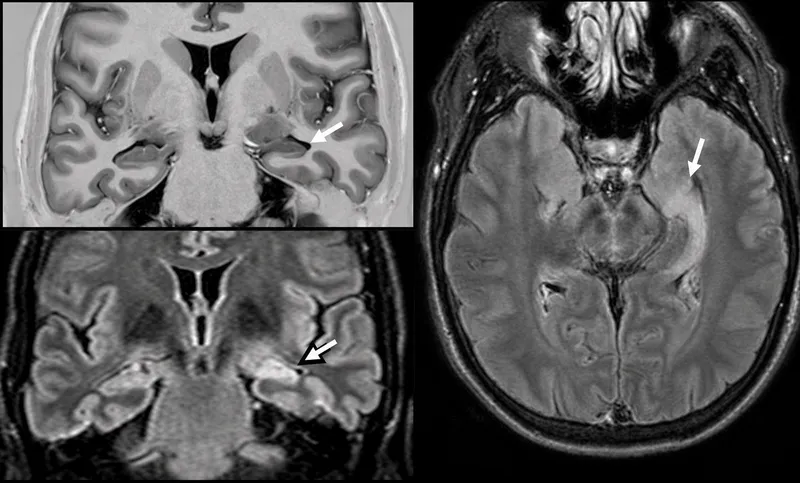 Brain MRI showing temporal lobe sclerosis with hippocampal atrophy