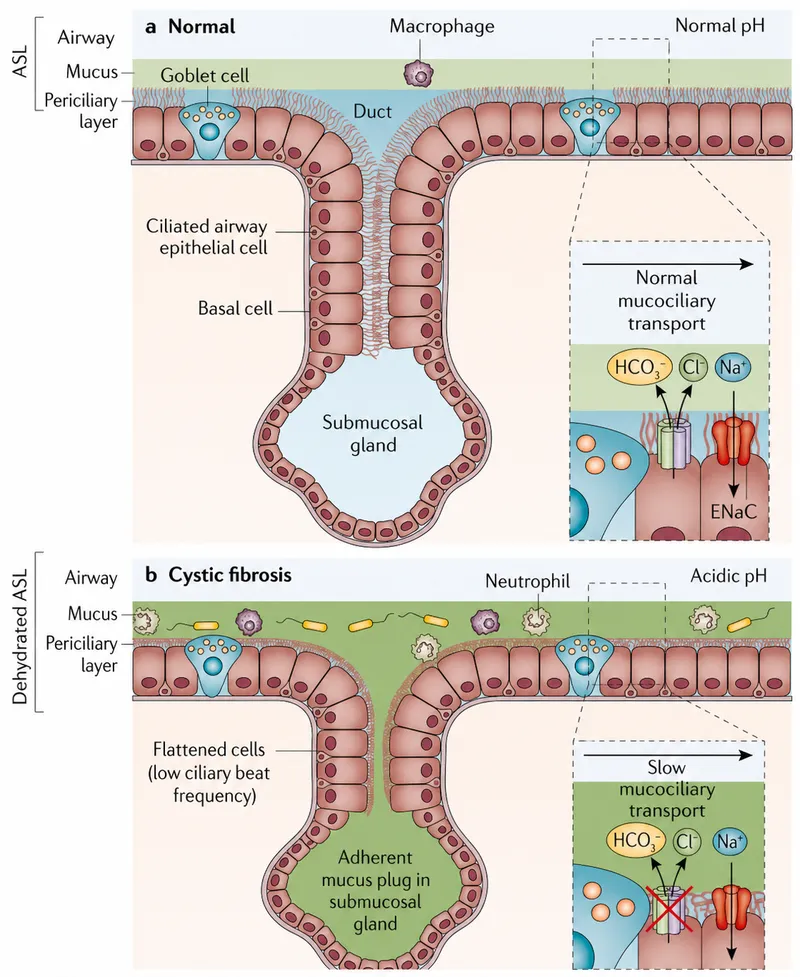 Normal vs CF airway epithelium and mucociliary transport
