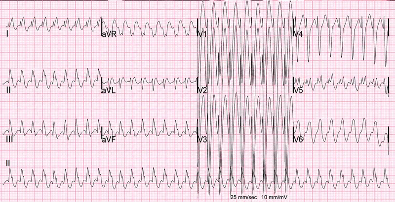 ECG: SVT converting to VT
