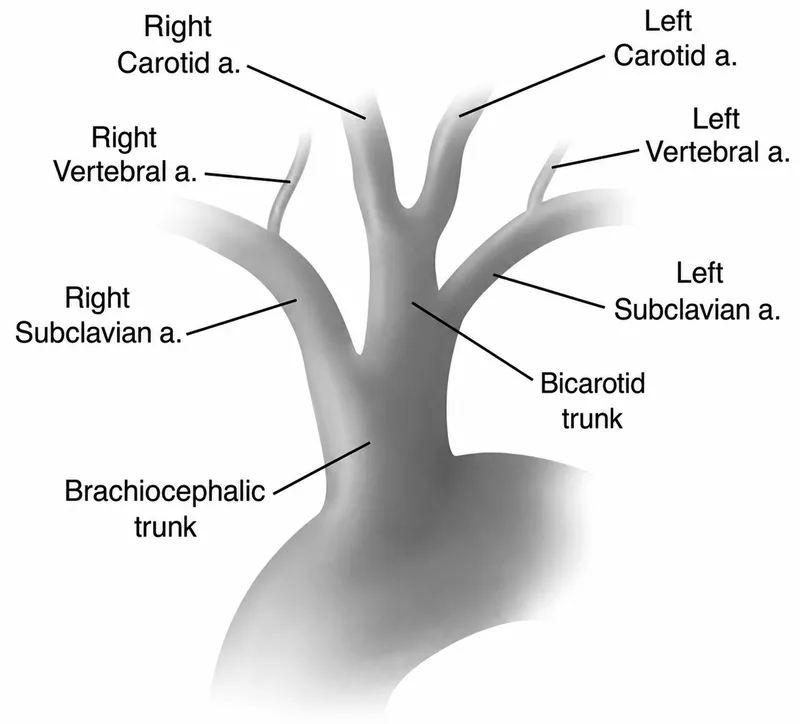 Bovine Aortic Arch Variation