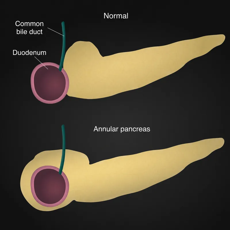 Annular pancreas vs normal anatomy
