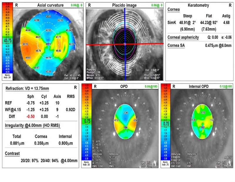 Corneal Topography and Tomography Report