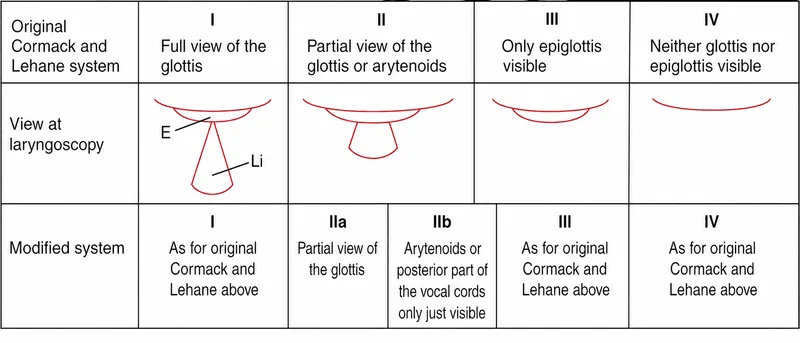 Cormack-Lehane Laryngoscopic Views