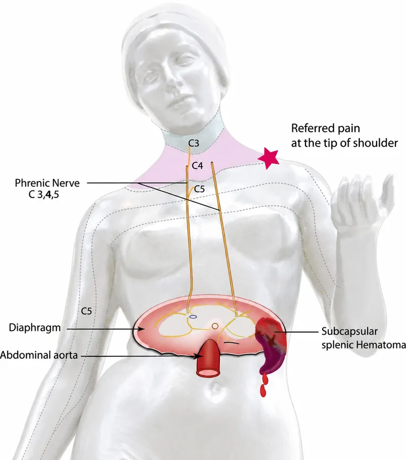 Kehr’s Sign: Referred Pain from Subcapsular Splenic Hematoma