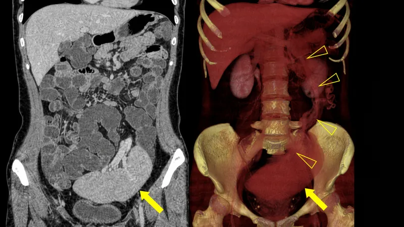 Wandering Spleen CT and 3D Reconstruction