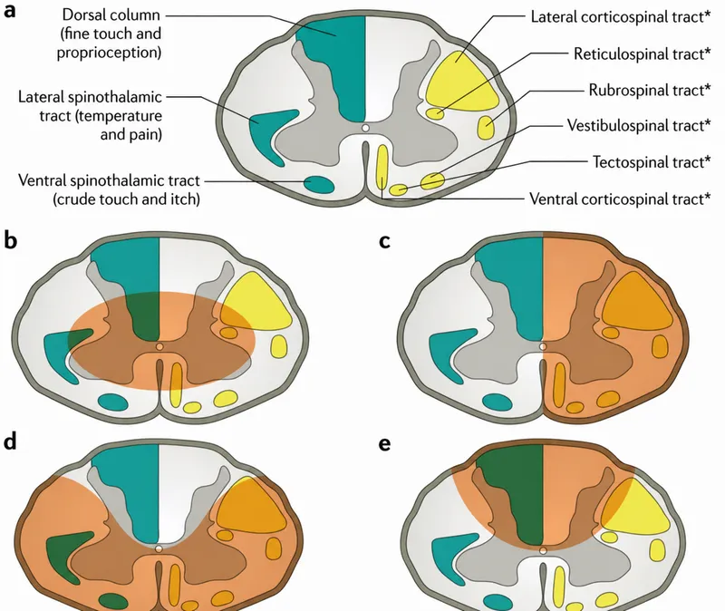 Spinal cord tracts and lesion locations