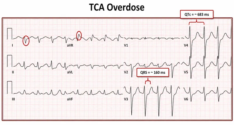 Figure 2: ECG showing prolonged QTc interval in patient on antipsychotic medication