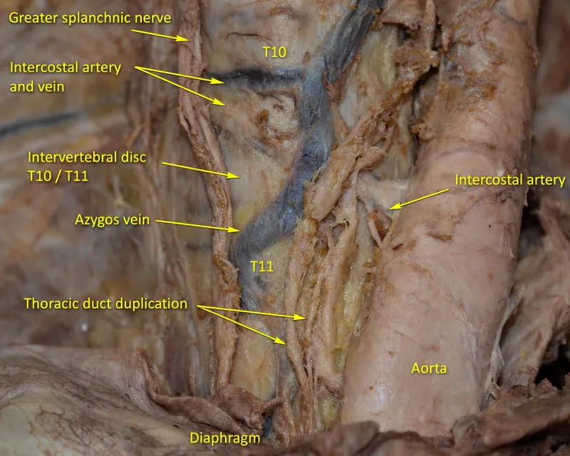Thoracic Duct Duplication and Azygos Vein Anatomy