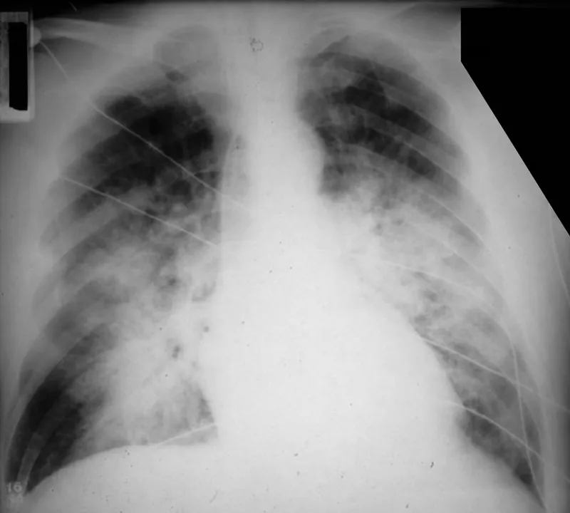 Chest X-ray: Bilateral diffuse opacities in ARDS