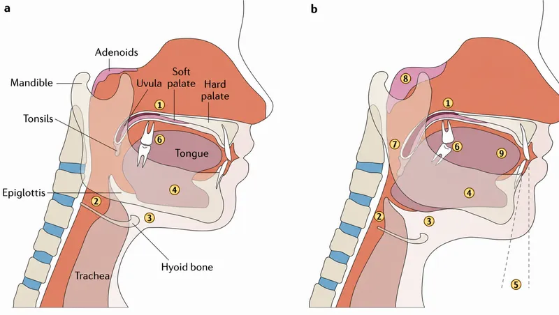 Upper airway anatomy in normal and OSA states