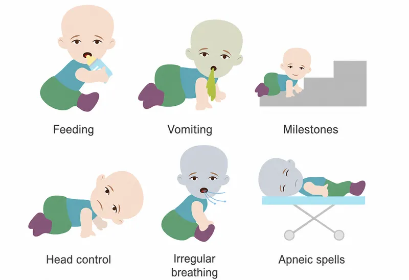 Signs of increased intracranial pressure in infants