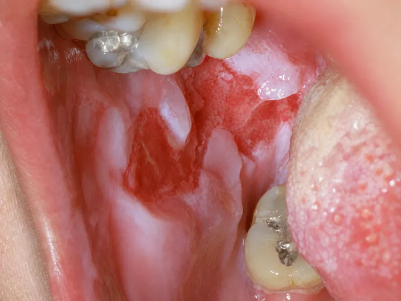 Pemphigus vulgaris oral lesions