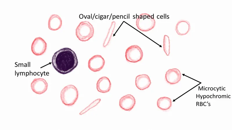 Peripheral smear: Microcytic hypochromic RBCs, pencil cells